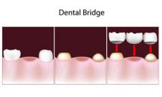  When most people hear the word “bridge,” they instantly think of a 
silver structure that takes you over a body of water, such as a river or
 lake. It connects one area of land to another. However, a bridge still 
connects one thing to another when it comes to dentistry, but there is 
no water involved. A dental bridge goes over a vacant dental area 
because a tooth is missing. It helps to secure the teeth on each side of
 the open space. visit: https://bothellwadentist.com/dental-clinic/bridges/ 