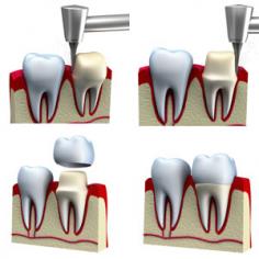  It is no secret that people might formulate an impression about you 
based on the condition of your smile. If you are presenting teeth that 
are decayed, chipped, cracked, or have other major dental woes, is there
 a solution that will restore the condition of your smile to its 
previous luster? Crowns, which are also referred to as tooth caps, could
 be a great restoration option that can enhance the look of your teeth 
while not putting too much of a dent in your budget. visit: https://bothellwadentist.com/dental-clinic/crowns/ 